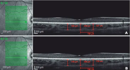 Figure 1. Choroidal thickness measurement. The cross-sectional image of the choroid was obtained  using enhanced depth imaging (EDI) scanning with optical coherence tomography
