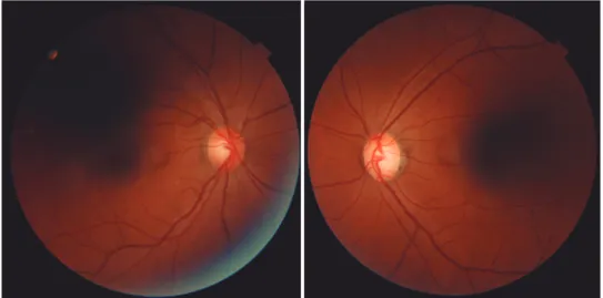 Figure 1. Retinography of right and left optic disc nerves. 