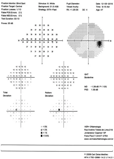 Figure 2. Visual field test of the right eye performed with the SITA 24-2 strategy. The image  shows a relative depression of the upper temporal field despite the normal results of the  glau-coma hemifield test
