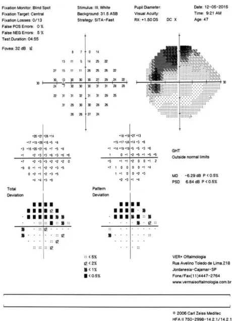 Figure 3. Visual field test of the left eye performed with the SITA 24-2 strategy. The image shows  a deep relative supero-nasal scotoma from 10 (zero dB) to 20 (26 dB)