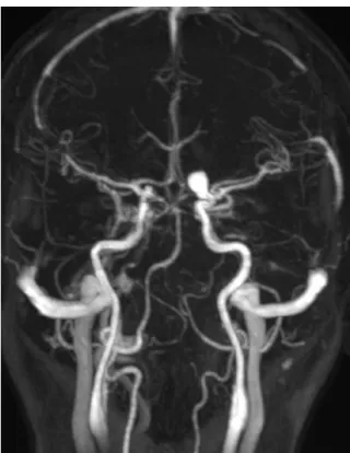 Figure 4. Preoperative T1-weighted contrast magnetic reso- reso-nance images showing a hyperintense aneurysm in the  ophthal-mic segment of the right internal carotid artery