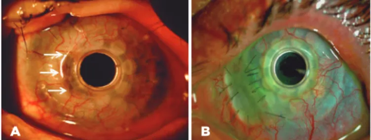 Figure 1. Slit lamp photographs of an implanted type 1 Boston KPro. 