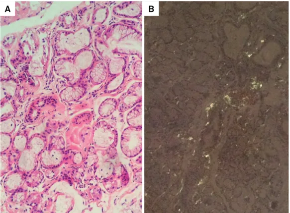 Figure 1. Salivary gland biopsy. A. Amorphous eosinophilic material deposition around some acini and stroma on H&amp;E staining
