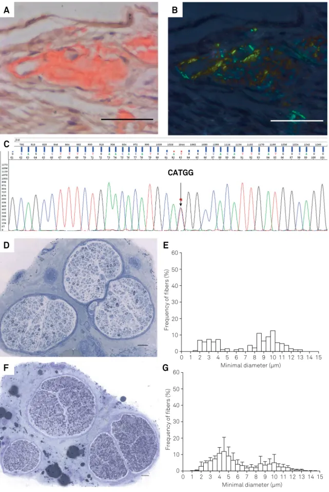 Figure 2. A. Amyloid material deposition in a vessel wall (left) and in the adjacent endoneurial space on Congo red staining (sural  nerve biopsy)