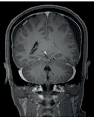 Figure 1. Coronal contrast-enhanced MR image with diffuse  pachymeningeal enhancement and bilateral subdural  hematoma, showing a decrease in size of the ventricles and  discrete dislocation of centroencephalic structures.