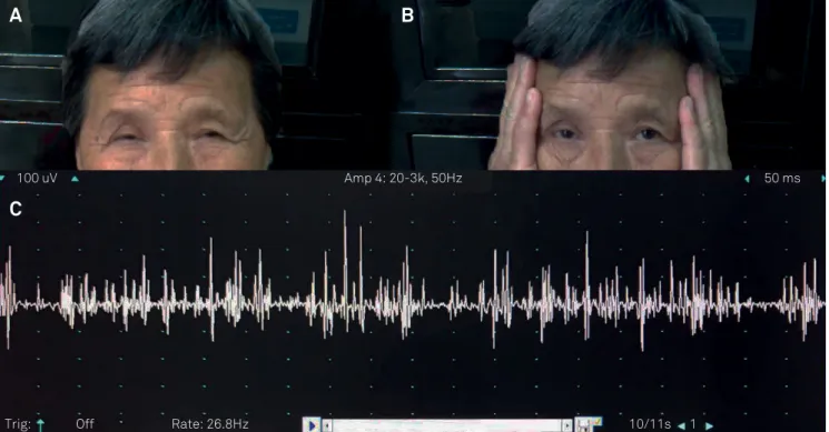 Figure 1. Sensory tricks and orbicularis electromyography of a blepharospasm patient with high anti-AChR Abs level