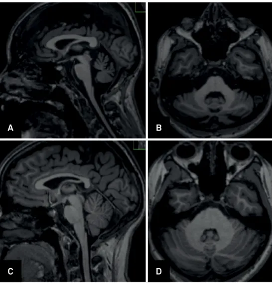 Figure 1. A. Sagittal T1-weighted brain MRI demonstrates cervical spinal cord atrophy in SCA1; B