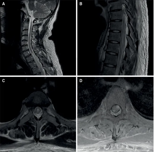Figure 1. MRI of the vertebral column of a patient with transverse myelitis caused by neurosyphilis