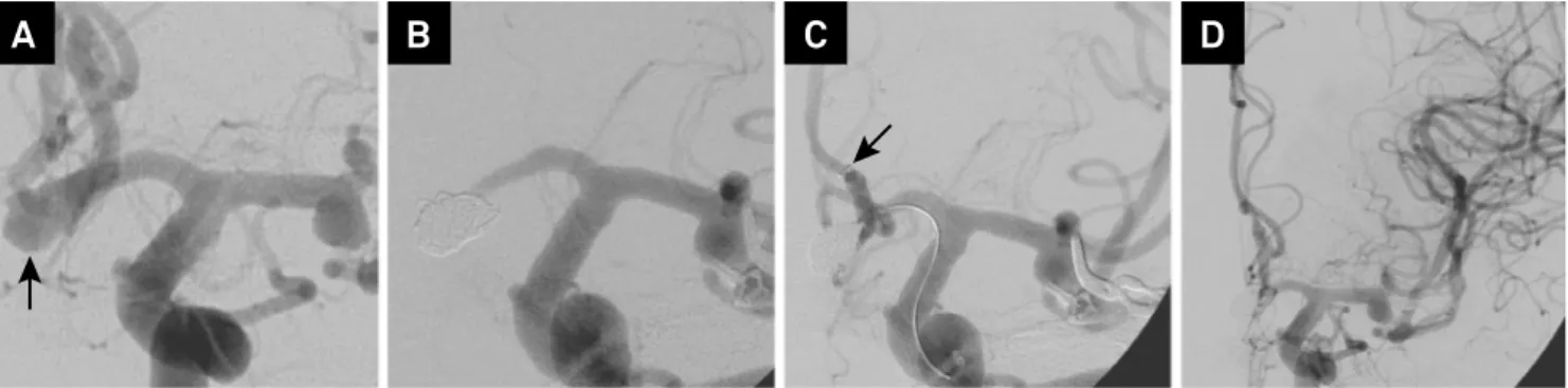 Figure 1. Patient 1 with anterior communicating artery aneurysm after middle cerebral artery aneurysm clipping