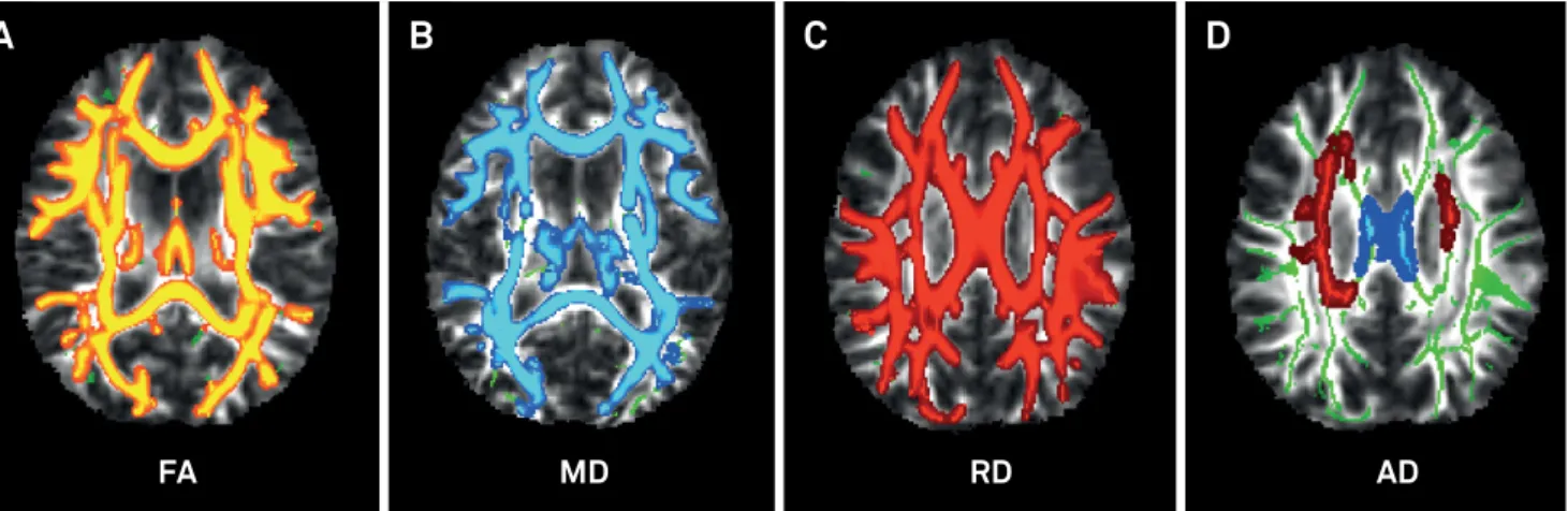 Figure 8. Twenty patients with acute moderate-to-severe TBI were compared with 20 age- and sex-matched controls with tract- tract-based spatial statistics