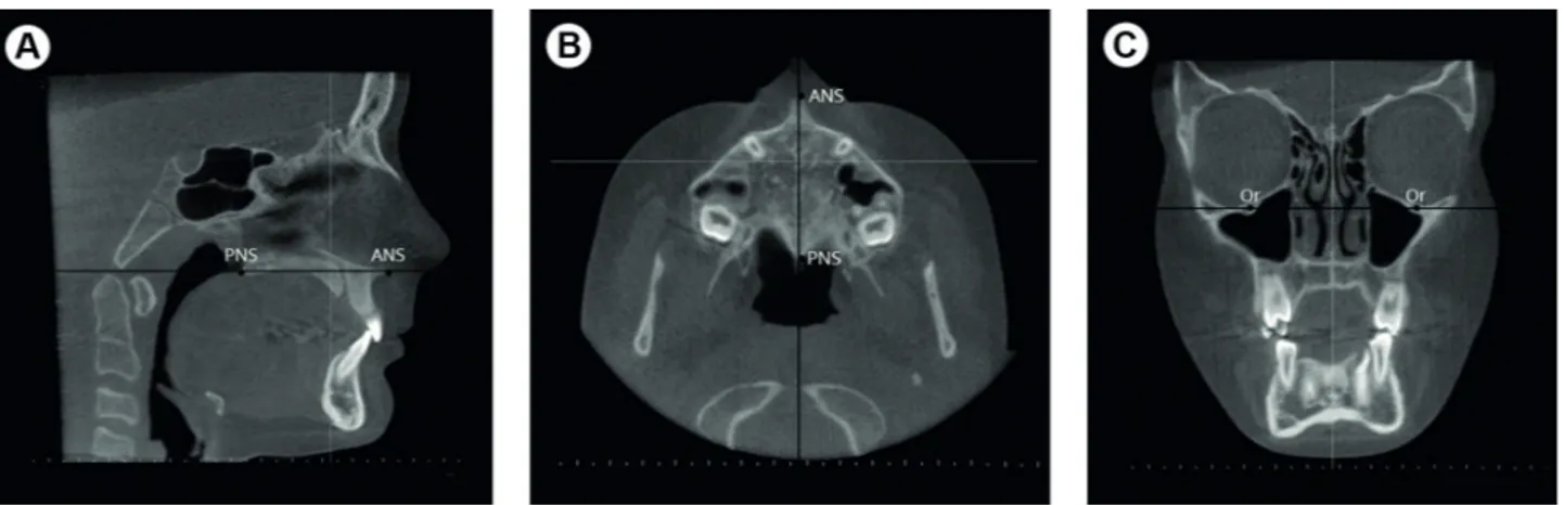 Figure 1. Standardized position of tomographic images. A: Sagittal plane. B: Axial plane