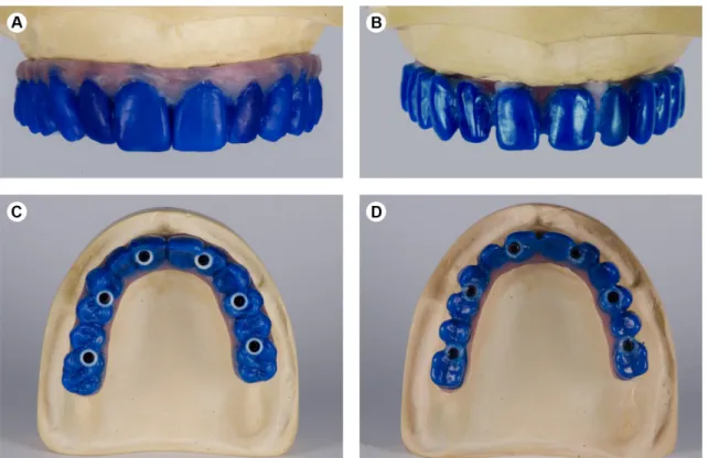 Figure 1. Full-arch fixed prostheses wax-up: (A) dimensions for final veneer ceramic (front view), (B) dimensions for the framework (front view),  (C) dimensions for final veneer ceramic (occlusal vision), and (D) dimensions for the framework (occlusal vis