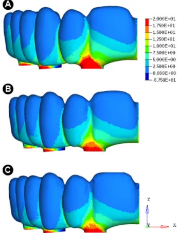 Figure 4. Maximum principal stress (MPa) distribution in the region of occlusal loading: (A) IPS e.max Ceram, (B) Vita VM9 and (C) Lava Ceram.