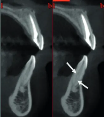 Figure 2. Mandibular incisor with two canals on cross-sectional  CBCT image.