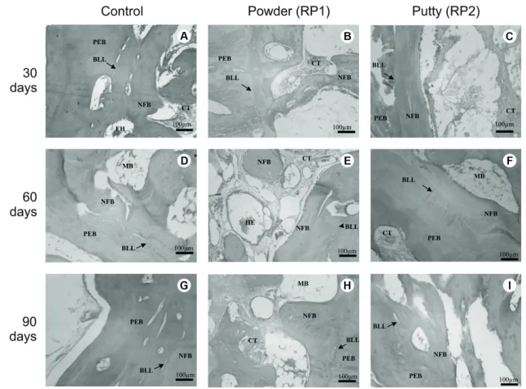 Figure 3. Photomicrographs of the periphery of the defects at different times after implantation: at 30 days (A) control, (B) RP1, (C) RP2; 60 days  (D) control, (E) RP1, (F) RP2; 90 days (G) control, (H) RP1, (I) RP2, showing the presence of: (NFB) newly 
