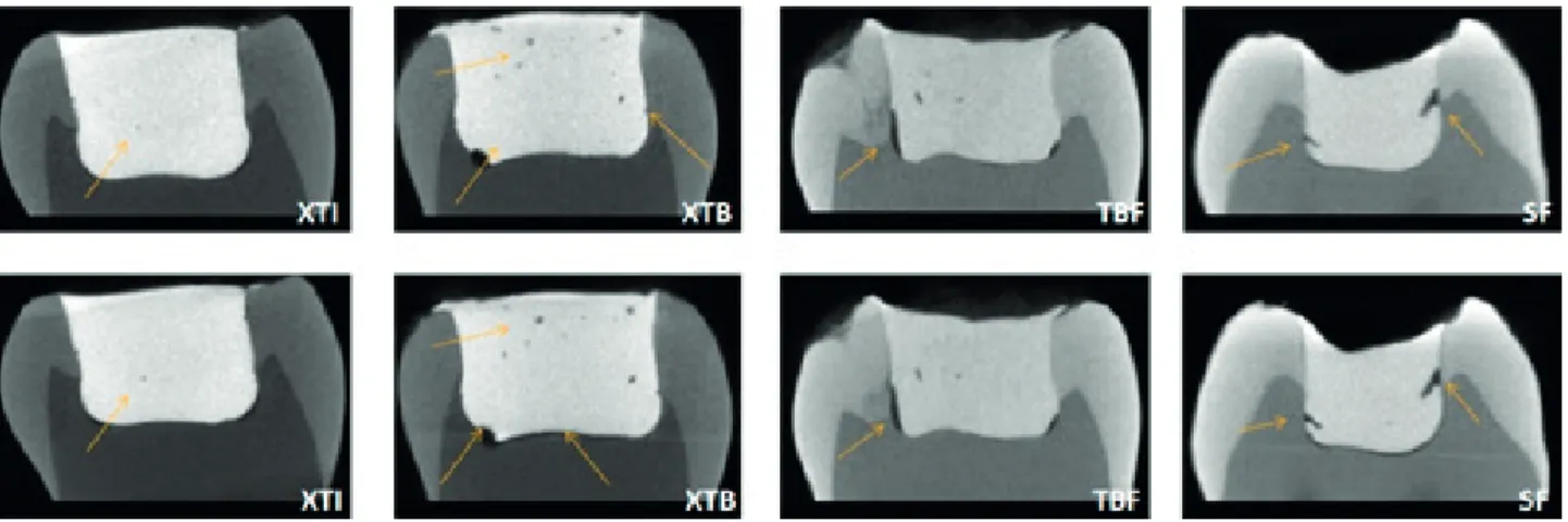 Figure 2. Cavity filling with composite before (upper) and after (lower) curing, respectively