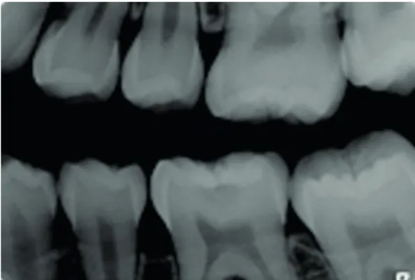 Figure 1. Radiographic image of an eligible molar (mandibular left  first molar) to this study
