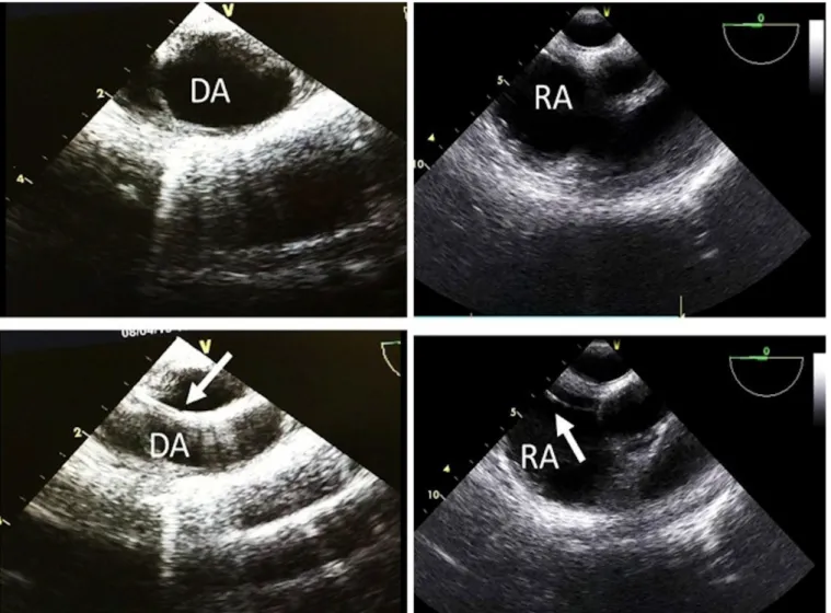 Fig. 2 - Intraoperative transesophageal echocardiography guidance images during peripheral cannulation