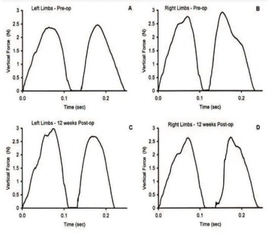 Figura 2.9 – (A, B) For¸cas verticais t´ıpicas pr´e-operat´orio. (C, D) For¸cas verticais t´ıpicas p´os-operat´orio.