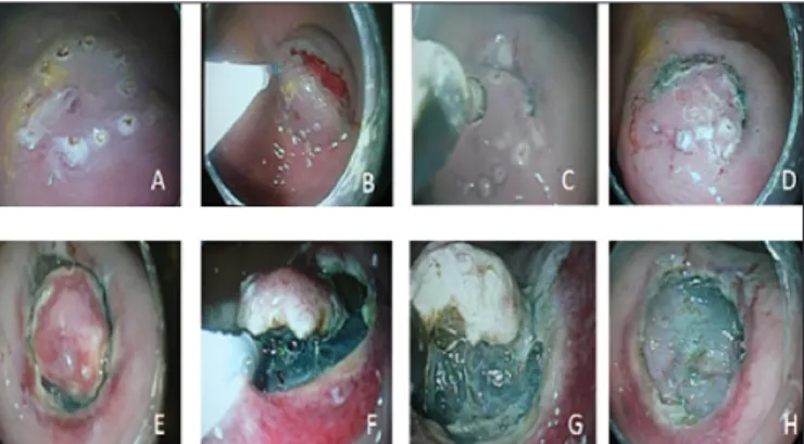 FIGURE 1. Schematic representation of the endoscopic submucosal dissec- dissec-tion (ESD) technique
