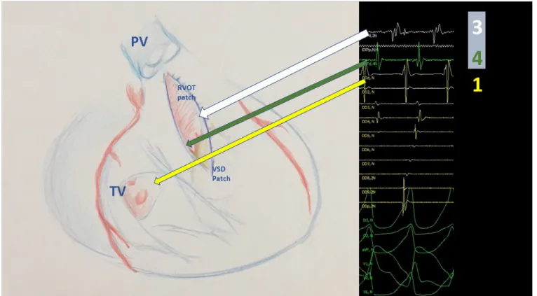 Fig. 1 – Disposition of catheters during EPS in search of mid-diastolic potentials. Proximal 20 – pole deflectable catheter – in yellow – on  isthmus number 4 (between septal tricuspid valve and VSD patch