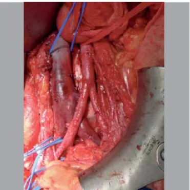 Figure 1. Surgery anterior access showing aorta artery, cava vein and iliac  common artery and vein.