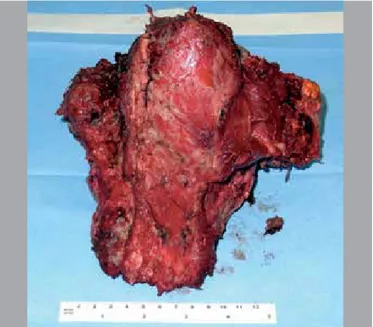 Figure 5. High-grade tumor of the peripheral nerve sheath en bloc resection.
