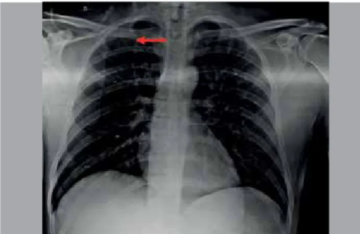 Figure 2. Chest x-ray showing the tip of the PICC positioned in the su- su-perior vena cava.