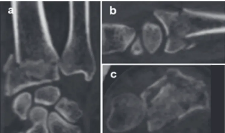 Figure 3. Tomographic images on coronal (A), sagittal (B) and axial (C)  planes depicting intra-articular radiocarpal and distal radio-ulnar fracture  of the distal end of the radius, associated with metaphyseal fragment,  fragmented, with angulation and r