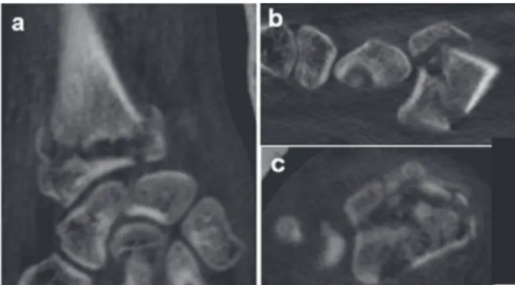 Figure 8. Tomographic images on coronal (A), sagittal (B) and axial (C)  planes depicting intra-articular radiocarpal and distal radio-ulnar fracture  of the distal end of the radius associated with radiocarpal volar dislocation,  from subgroup IIIB.