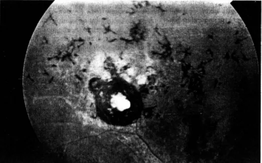 Fig.  3:  Caso  5  - Retinografia apresentando cicatriz de retinocoroidite temporal superior, embainhamento e  retificação  dos  vasos além de osteoclastos próximos  à  lesão