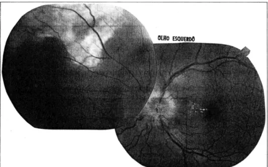 Figura  2  - Papilite, edema e exsudatos maculares e fibrose sub-retiniana na  média periférica (OE)