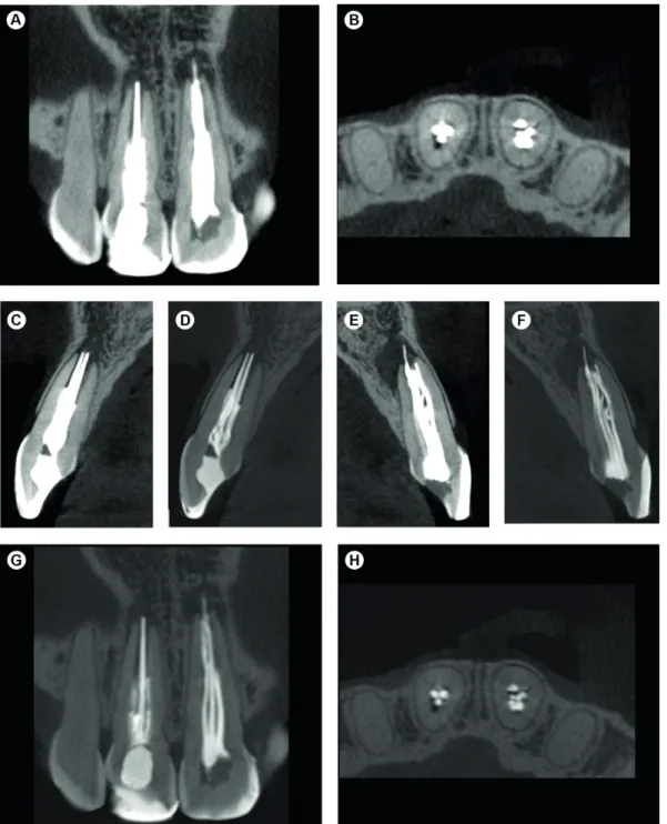 Figure 1. (A-B) CBCT report  produced by e-Vol DX shows the teeth # 11 and 21 with white contrast artifacts, which make it difficult to identify  the failed root canal treatment; (C-H) in the e-Vol DX CBCT images, the filter was used and the contrast of th