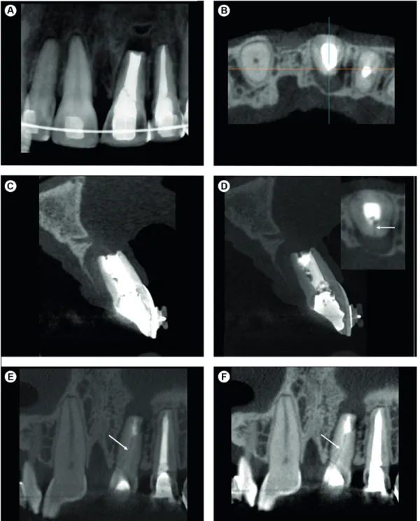 Figure 2. (A-B) e-Vol DX CBCT images showing tooth # 21 with white contrast artifact prevents the visualization of a vertical  root fracture and  hides a lateral rarefaction; (C-F) In CBCT images produced with a filter for normal contrast of the grayscale,