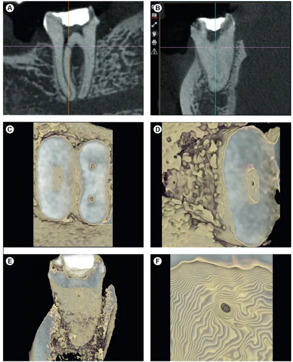 Figure 3. (A-B) The e-Vol DX CBCT images reveals a lateral canal in tooth # 37; (C-F) The filter favor the visualization of anatomical details of  this inner lateral canal and its external surface (periodontal ligament) may be seen clearly at higher magnif