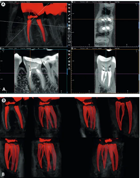 Figure 5. (A-B) The e-Vol DX CBCT images showing tooth #36 with detailed information about root canal obturation, and may also provide  information about the absence or presence of periapical osteolysis