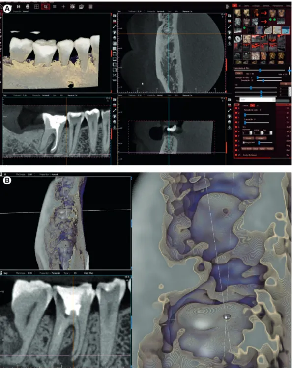 Figure 6. (A-B) The e-Vol DX CBCT images shows the shape and position of the apical foramen of tooth #35