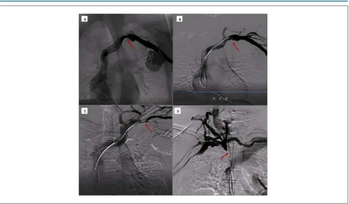 Figure 3 –  Classification  of  venous  lesions  and  collateral  circulation.  Examples  of  the  four  types  of  lesion  according  to  the  classification  adopted  in  the  study