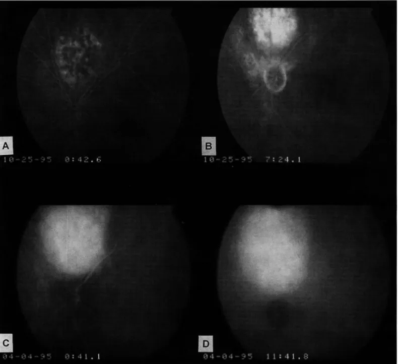 Fig.  1  - Caso  1 :   Hemangioma.  (A  e  B):  Video-angiog rafia  digital  pela  fluoresceín a :   A
