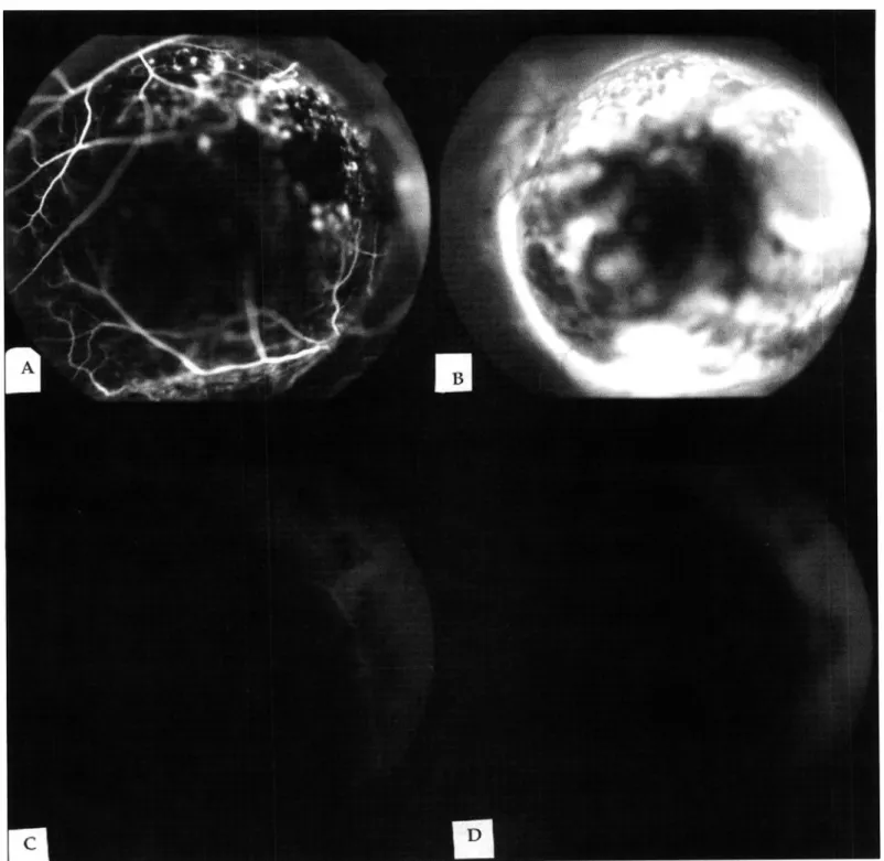 Fig.  4  - caso  1 2 :   Melanoma maligno. (A e  B): Vídeo-angiografia digital  pi;I� fluoresceína:  &#34;':·  H i perfl�ores�ên?ii;t  precoc� e  irr�g�lar do tu r:n or