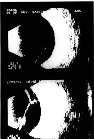 Fig.  3  - Imagem  ultrassonográfica  em  B-scan  do  olho  simpatizado  antes  do  tratamento  com  imunossupressão  sistêmica  e  enucleação  do olho 