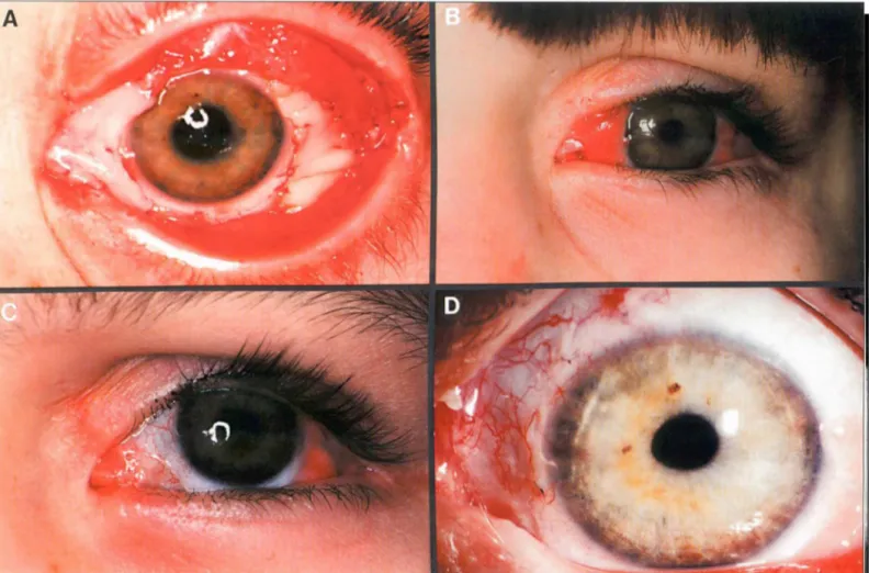 Fig.  1  - A)  Pós-operatório de cirurgia de reconstrução da s uperfície conj u ntiva!, com  m ucosa  labial,  para  injúria  por fórceps ao nascimento