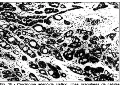 Fig.  18  - Carcinoma  adenóide  cístico:  ilhas  i rregulares  de  células  epiteliais 
