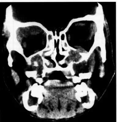 Fig.  12  - Lise óssea  no rebordo temporal  superior direito e  assoalho  esquerdo em  u m  raro caso de l infoma de alto grau em criança