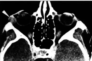 Fig.  1 5   - Adenoma  pleomorfo  de  glândula  lacrimal. 