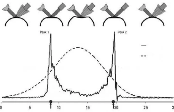 Figure 1. Peak 1 and Peak 2 in ocular response analyzer.