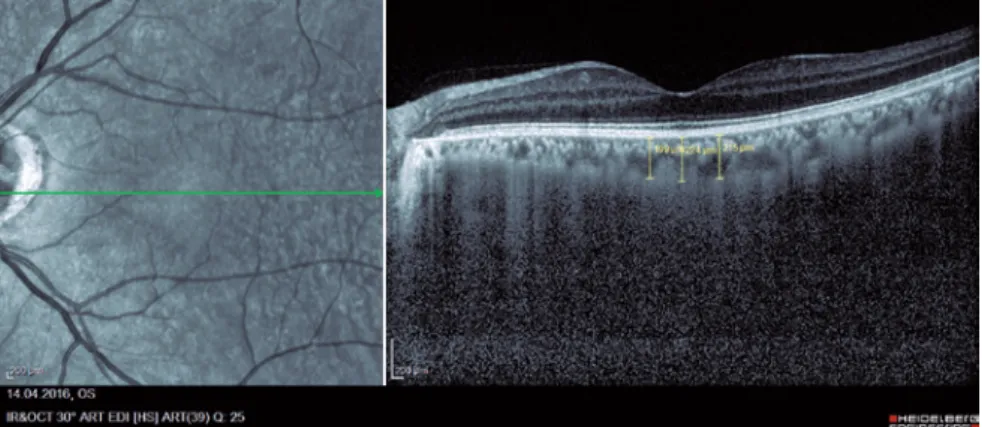 Figure 2. Example of choroidal thickness in an obese patient.