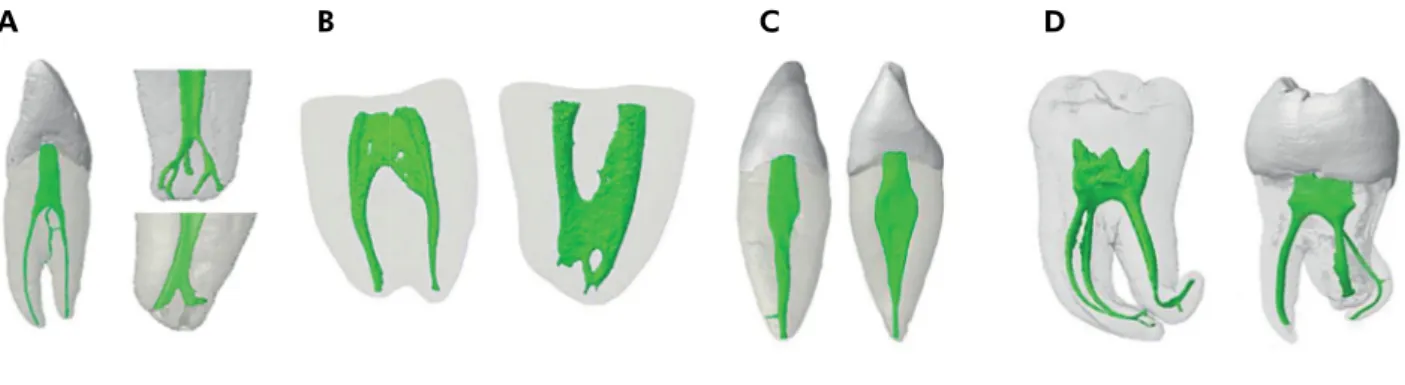 Figure 1. Three-dimensional models of root canal system of human teeth obtained from microcomputed tomography scanning showing  the importance of the diagnosis of anatomical challenges prior to the biomechanical preparation of the root canal system
