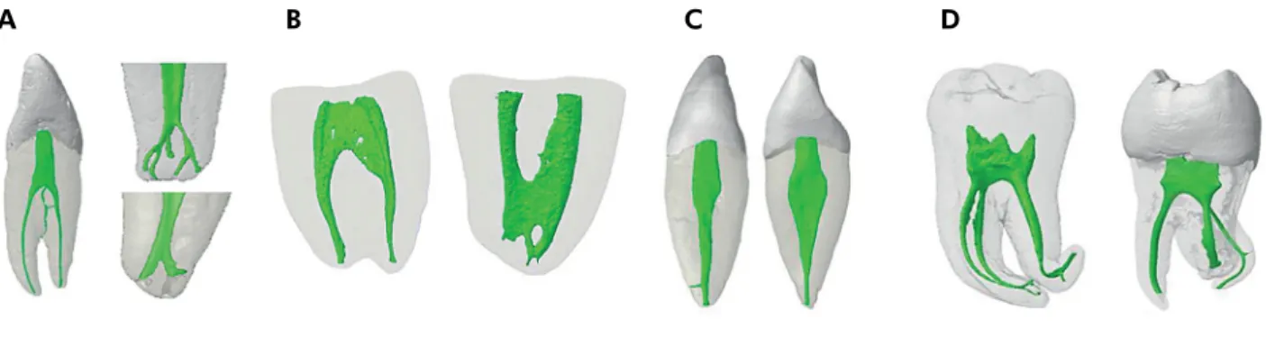Figure 1. Three-dimensional models of root canal system of human teeth obtained from microcomputed tomography scanning showing  the importance of the diagnosis of anatomical challenges prior to the biomechanical preparation of the root canal system