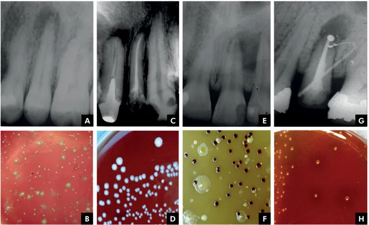 Figure 2 illustrates the radiographic aspects and  microbiological findings observed in each type of  infection